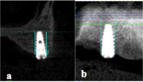 The Peri Implant Bone Height Was Measured A At Buccal And Palatal