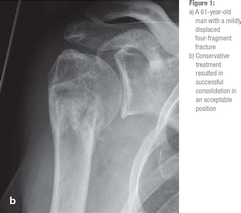 Figure 1 from The treatment of proximal humeral fracture in adults ...