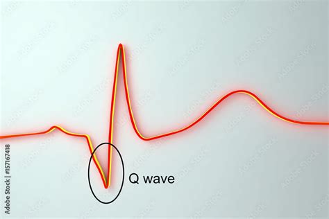 ECG In Myocardial Infarction 3D Illustration Showing Pathological Q