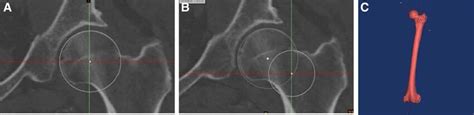 Determination Of The Femoral Neck Axis A Generating Best Fit Sphere