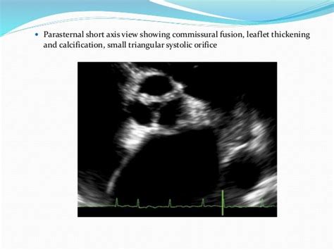 Aortic Stenosis Echocardiography