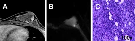 Female 44 Years Old Plasma Cell Mastitis A The Enhanced Ring On