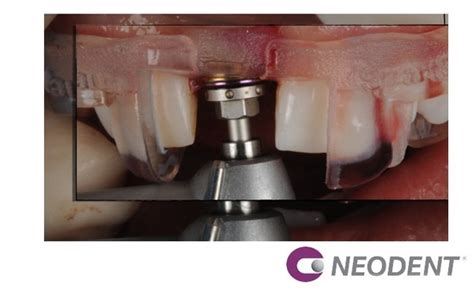 Cirurgia Guiada Ngs Para A Instala O Do Helix Gm Carga Imediata