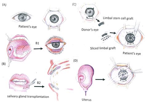 Ocular Surface Reconstruction Of Steven Johnson Syndrome Toxic