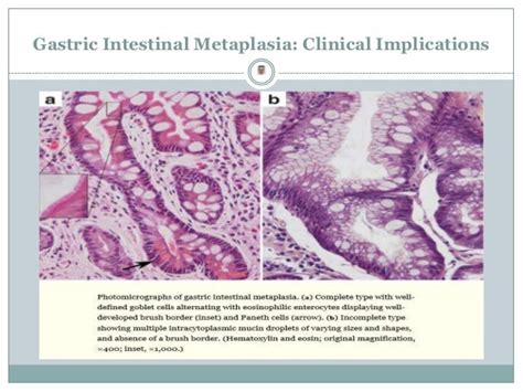 Gastric Intestinal Metaplasia - Clinical Implications