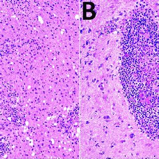 Histologic Analysis Of A Brain Biopsy Specimen From A Year Old