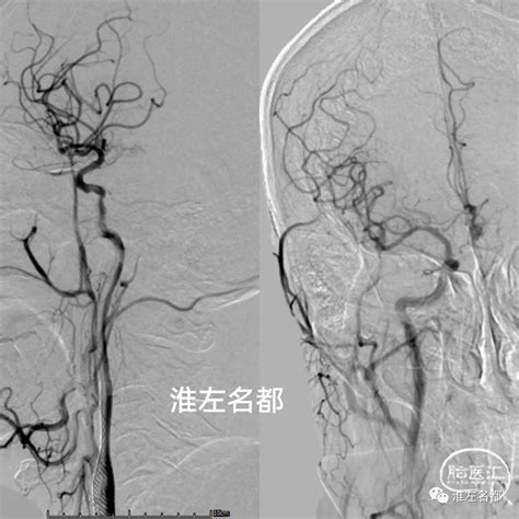 双侧颈动脉狭窄 闭塞病变同期介入治疗（左慢闭右重窄） 脑医汇 神外资讯 神介资讯