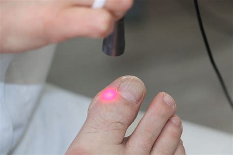 Onychomycosis Treatment With Diode Laser Activeducation Academy