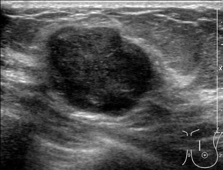 Phyllodes Tumor Image Radiopaedia Org