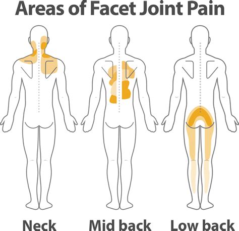 What is Facet Joint Pain - PMCOA