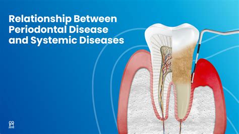 Periodontology Periodontal Diseases In Antalya Akar Dental