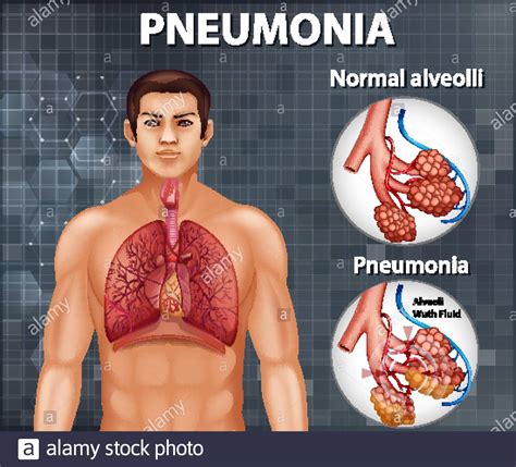 Healthy Lung Alveoli Fotos Und Bildmaterial In Hoher Aufl Sung Alamy