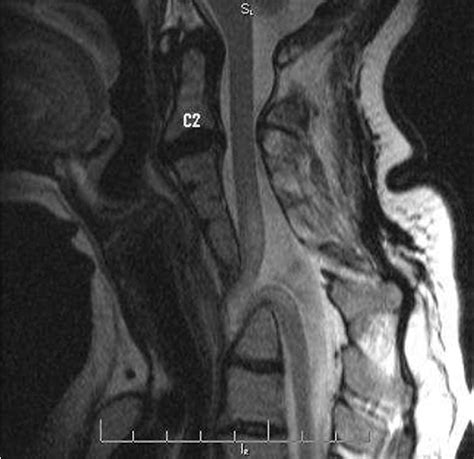 Figure 1 From Klippel Feil Syndrome And Anterior Cervical