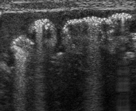 Necrotizing Enterocolitis Ultrasound