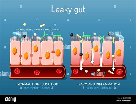 Leaky Gut Close Up Of Cells Of A Intestinal Epithelium Difference