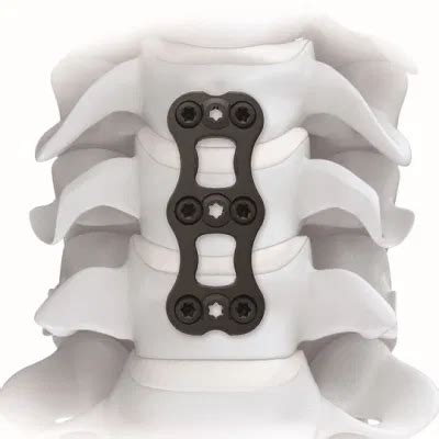 Anterior Cervical Plate Canacp Orthopaedic Implants Titanium Spine