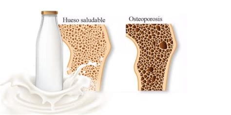 La Osteoporosis Y Su Asociación Sobre El Consumo De Lácteos