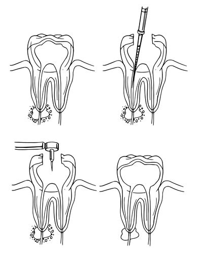 Don't Believe These Root Canal Myths | Summit Dental Care