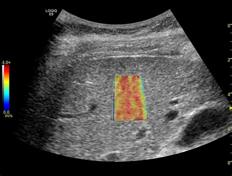 A better evaluation of liver fibrosis | Radiology Report