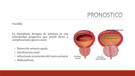 Hiperplasia Prostática Benigna Ppt