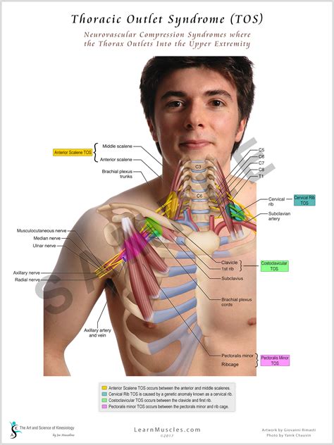 Thoracic Outlet Syndrome 18 X 24 Premium Poster Learn Muscles