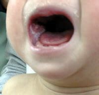 Oral Thrush Candida Albicans - Lone Parenting