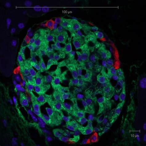 Transplantation After Pancreas Removal May Help Blood Sugar