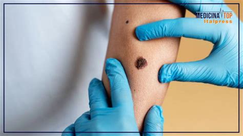 Passi Avanti Nella Cura Del Melanoma Presto Il Vaccino