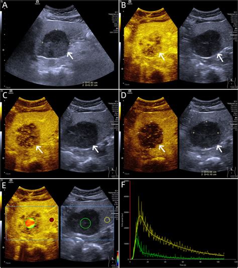 Applications Of Dynamic Contrast Enhanced Ultrasound In Differential Diagnosis Of Hepatocellular