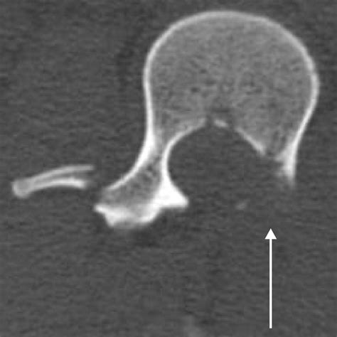 Chance Type Fractures Of The Thoracolumbar Spine Imaging Analysis In