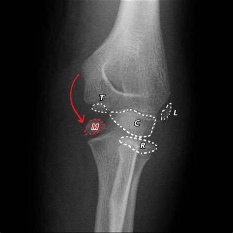 Medial Epicondyle Fracture X Ray at Johnny Whitney blog