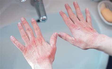 Managing Hand Eczema - Eczema Awareness Monthly - An American Academy ...