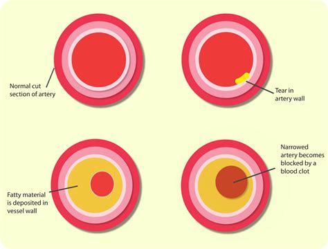 Cross Section Of An Artery