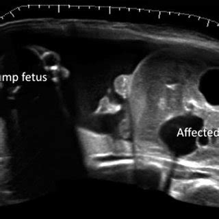 Extended Field Of View Ultrasound Image Of The Two Fetuses In A Case Of