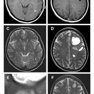 Brain MRI findings. A, B Gadolinium-enhanced brain MRI revealed strong ...