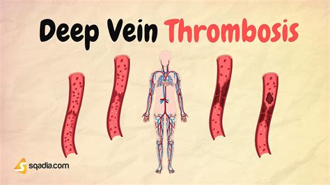 Deep Vein Thrombosis