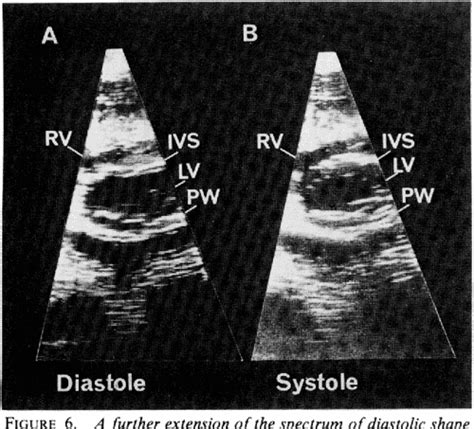 PDF Mechanism Of Abnormal Septal Motion In Patients With Right