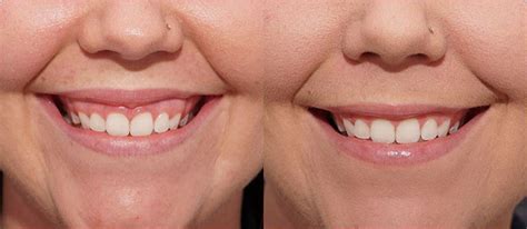 Gummy Smile Maticlinic Aesthetics ǀ Anti Wrinkle Injections ǀ Dermal