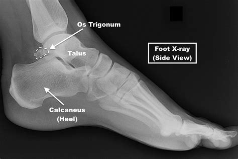 Os Trigonum Syndrome