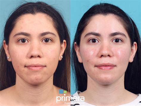 Buccal Fat Removal For Orlando Winter Park Fl Primera Plastic Surgery