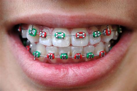 Orthodontics Australia | What to Do When Your Braces Wire Breaks?