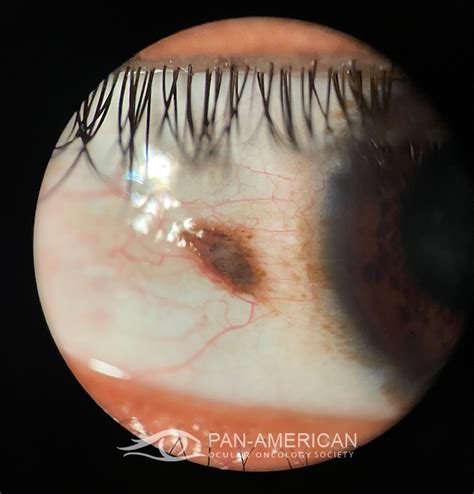 Racial Melanosis And Conjunctival Nevus Sociedad Panamericana De