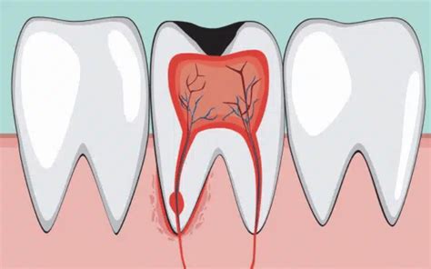 What Is A Pediatric Pulpotomy Introduction To Pediatric Pulpotomy By Little Dental Pediatric