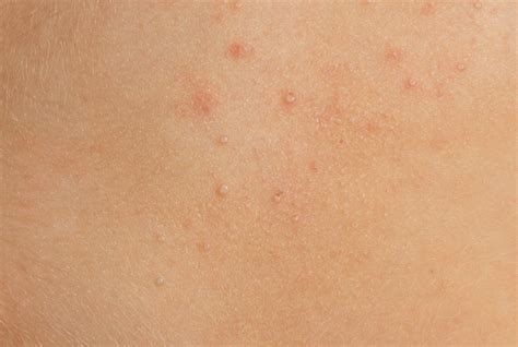 Molluscum Contagiosum Virus