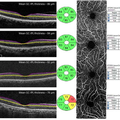 Comparison Of The Ganglion Cell Inner Plexiform Layer Thickness Among