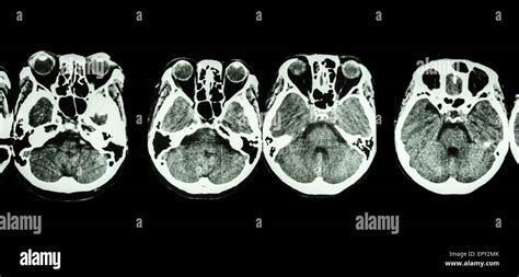 CT scan of brain and base of skull ( show structure of eye , ethmoid sinus , cerebellum ...