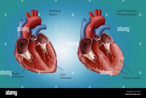 Illustration Showing A Normal Heart At Left And A Heart With Left