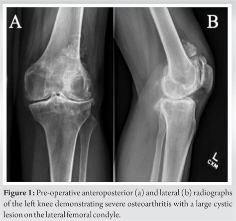 Management Of A Massive Solitary Femoral Condyle Bone Cyst At The Site Of Knee Osteoarthritis