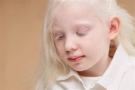 Premium Photo Close Up Portrait Of Little Caucasian Girl With Albinism Syndrome