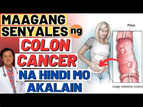 Maagang Senyales Ng Colon Can Cer Na Hindi Mo Akalain Tips By Doc